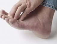 Лікування грибкової інфекції на ногах