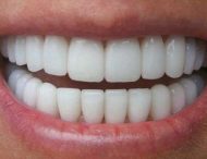 Популярні міфи про відбілювання зубів