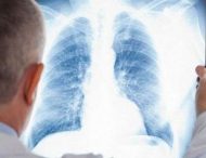 Причини розвитку раку легенів