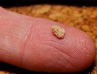 Причини появи каменів у нирках