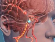 Як визначити аневризму головного мозку?