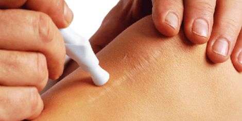 Абдоминопластика или удаление растяжек на животе после родов Абдоминопластика или удаление растяжек на животе после родов