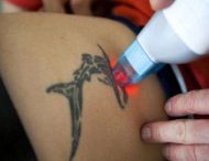 Сучасні методи видалення татуювань