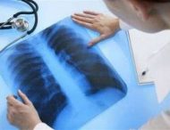 Симптоми та лікування туберкульозу
