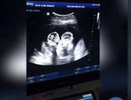 “Бійку” близнюків в утробі матері побачили на узі (відео)